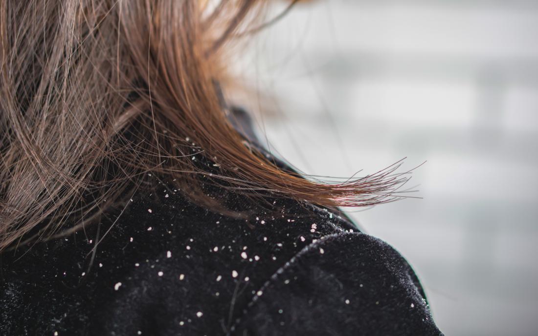Remedy Of The Month – Dreaded Dandruff